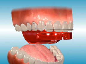 orthodontic appliances