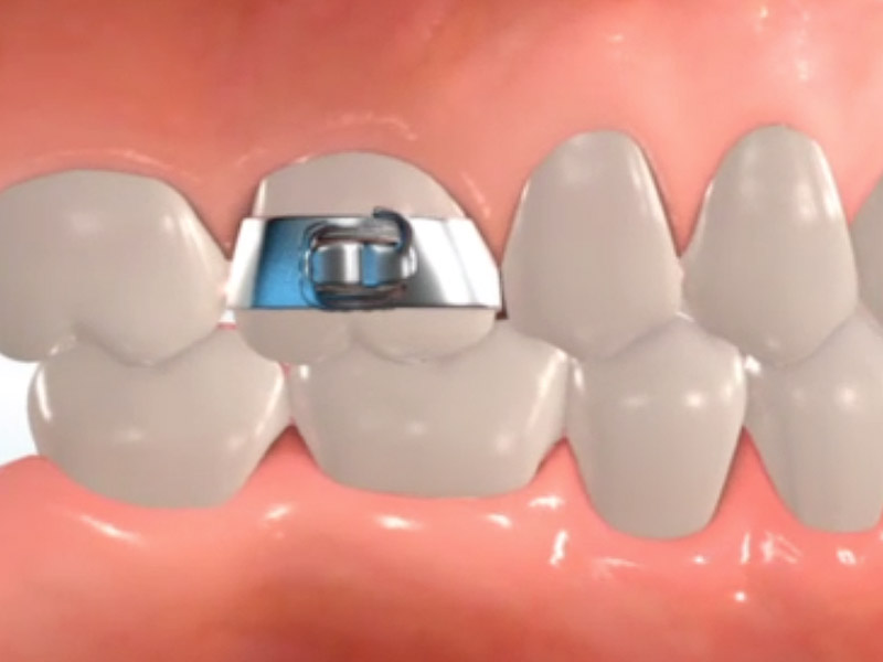 orthodontic appliances