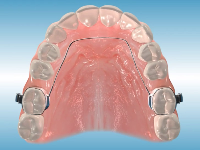 orthodontic appliances