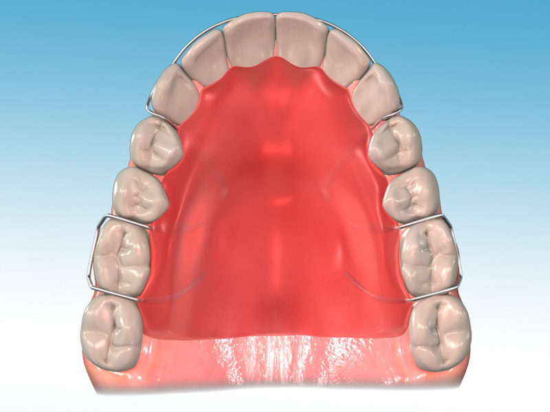 orthodontic appliances