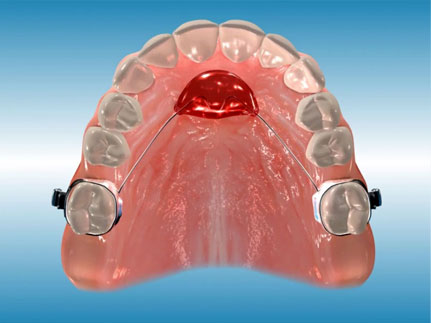 orthodontic appliances