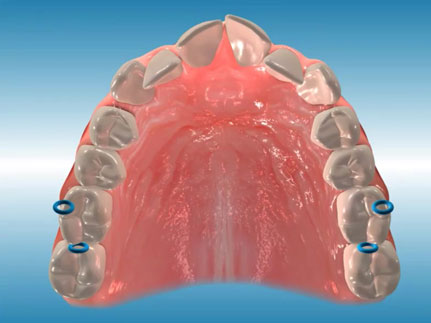 orthodontic appliances