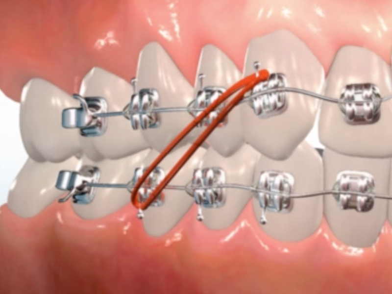 orthodontic appliances