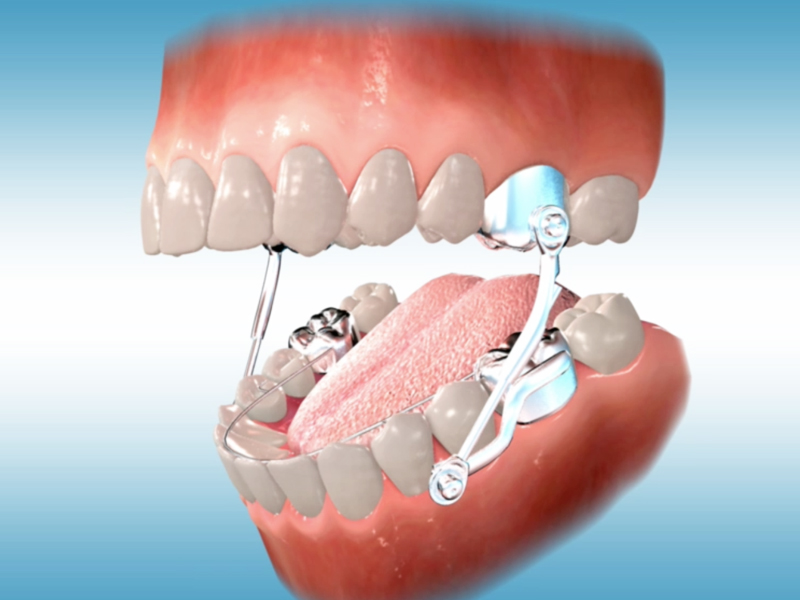 orthodontic appliances