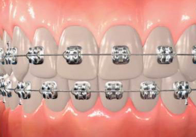 orthodontic appliances