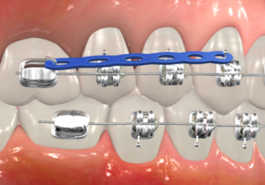 orthodontic appliances