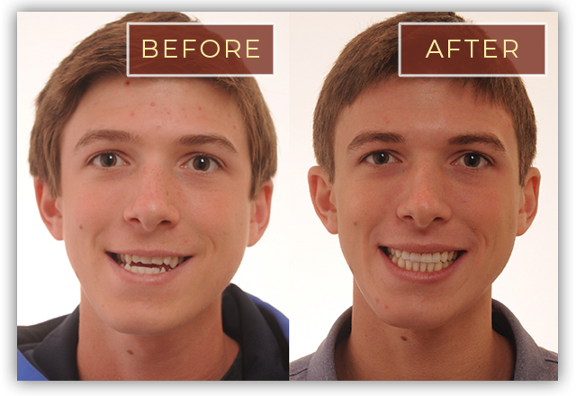 Braces Before And After Smile