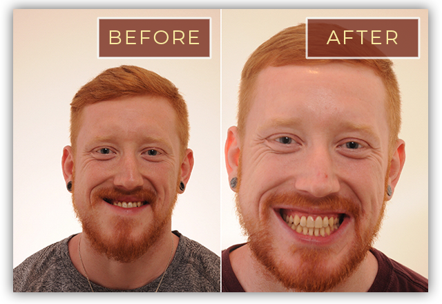 before and after braces adults