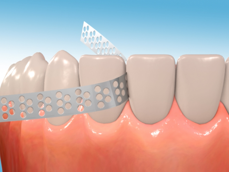 orthodontic terms